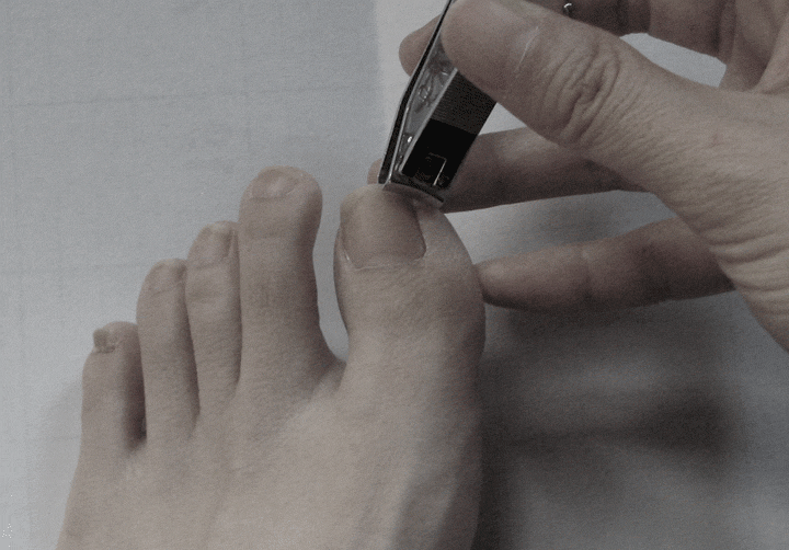 新しい爪が生えてきたとしても、爪際の隙間などに菌が残っている可能性がある。