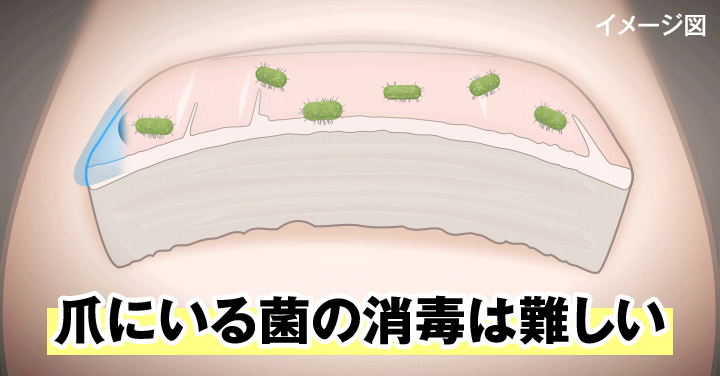 爪の菌の消毒は難しい。