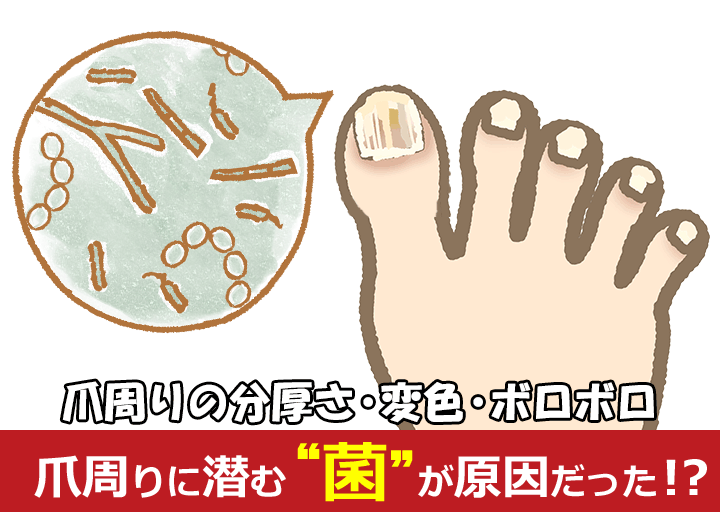 爪周りの分厚さ・変色・ボロボロは、爪に潜む菌（爪水虫、白癬菌）が原因だった！？
